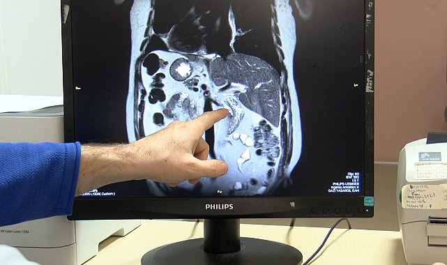 Bütün iç organları ters yerde; karın ağrısı şikayetinden dünyada yapılan 47'nci işlemle kurtuldu
