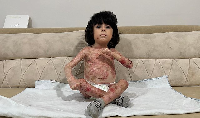 4 yaşındaki İbrahim, 'Kelebek hastalığı' nedeniyle kıyafet giyemiyor