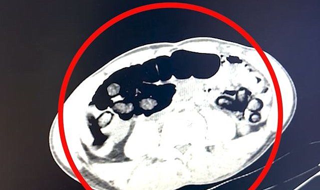 Batman'da 4 şüphelinin midesinden 2 kilo 700 gram uyuşturucu çıktı