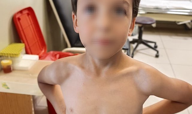 7 yaşındaki Mustafa'nın göğsüne kene yapıştı