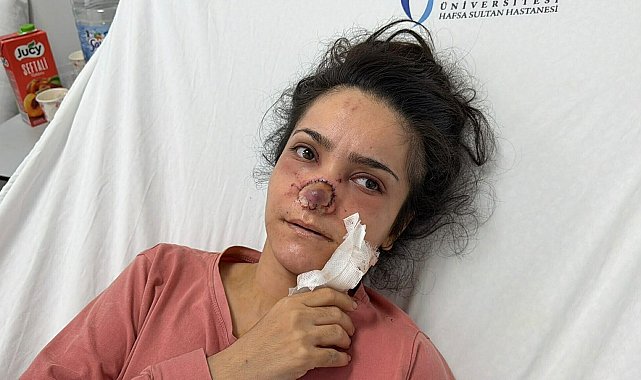 Eşi tarafından burnu ısırılıp koparılan İmran: Canımın acıyla balkondan atlamayı bile düşündüm